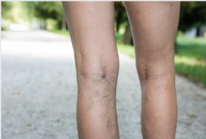 varicose vein removal cost